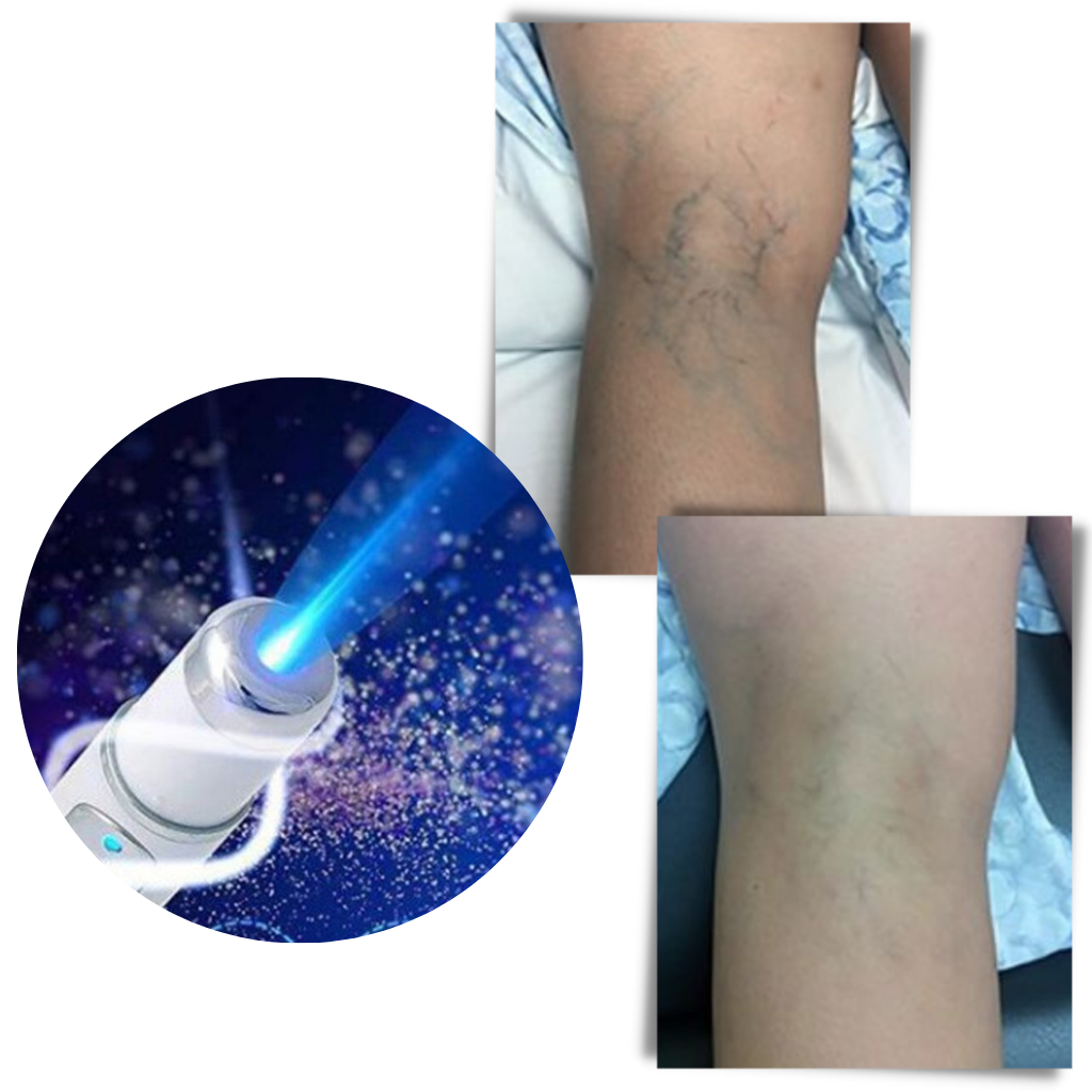 Bolígrafo de terapia cutánea con luz azul