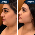 FaceLift™ Reductor de Arrugas y Papada – Recuperá un Rostro Más Firme y Definido + Crema Exclusiva de Regalo