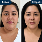 FaceLift™ Reductor de Arrugas y Papada – Recuperá un Rostro Más Firme y Definido + Crema Exclusiva de Regalo