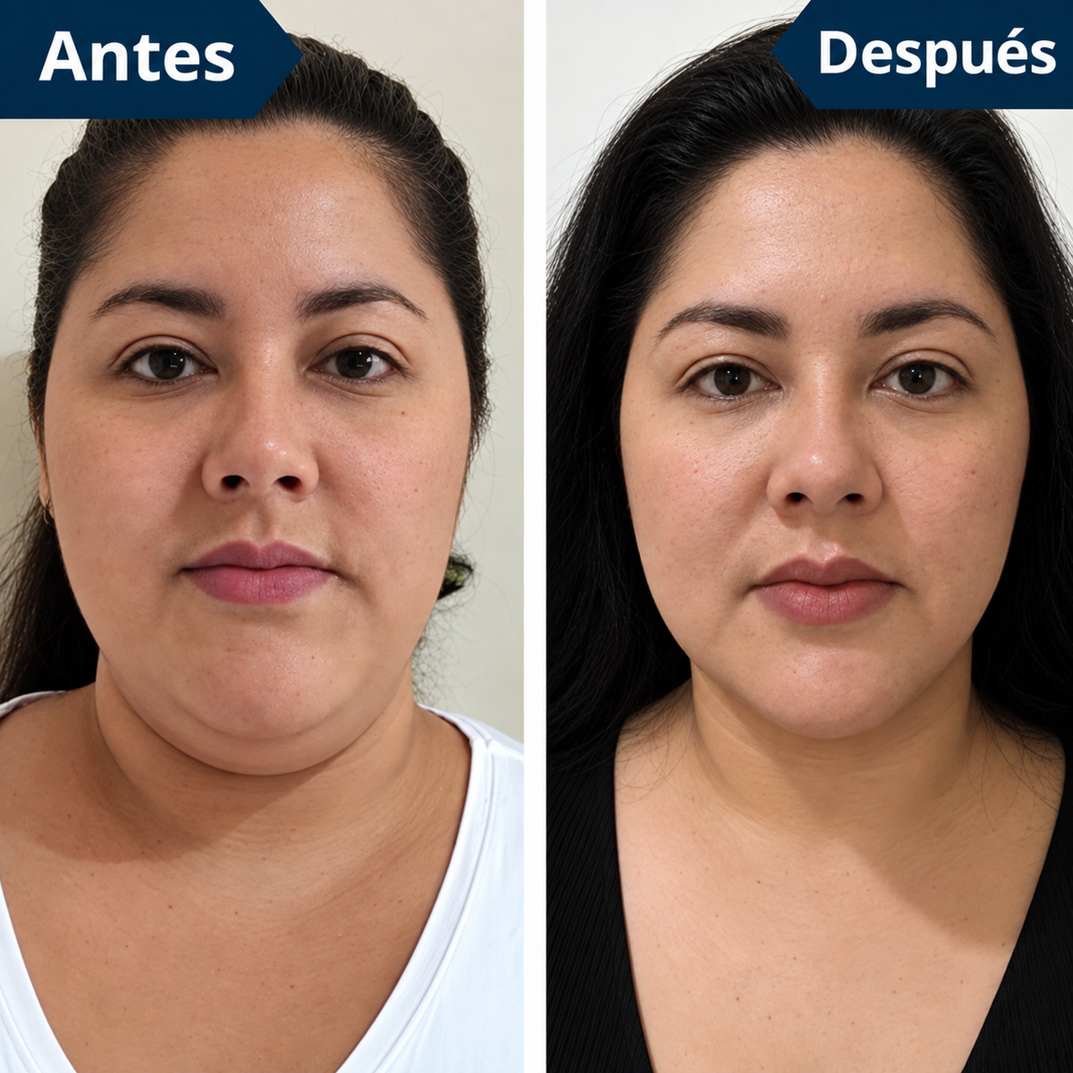 FaceLift™ Reductor de Arrugas y Papada – Recuperá un Rostro Más Firme y Definido + Crema Exclusiva de Regalo