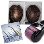 Rodillo Derma para el crecimiento del cabello y la barba