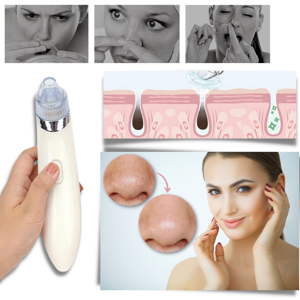 Set de eliminador facial de puntos negros