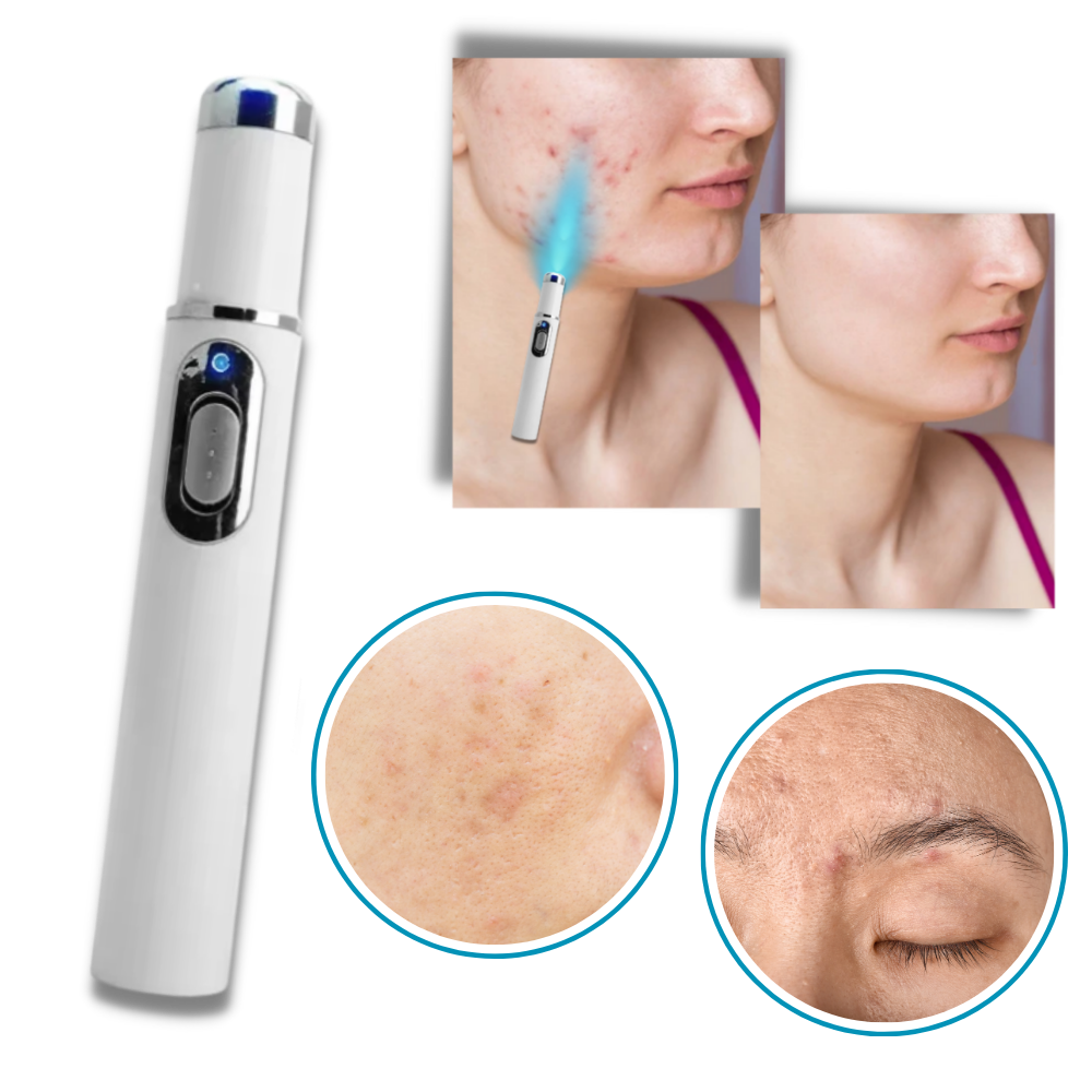 Bolígrafo eliminador de imperfecciones mediante láser
