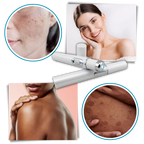 Bolígrafo eliminador de imperfecciones mediante láser