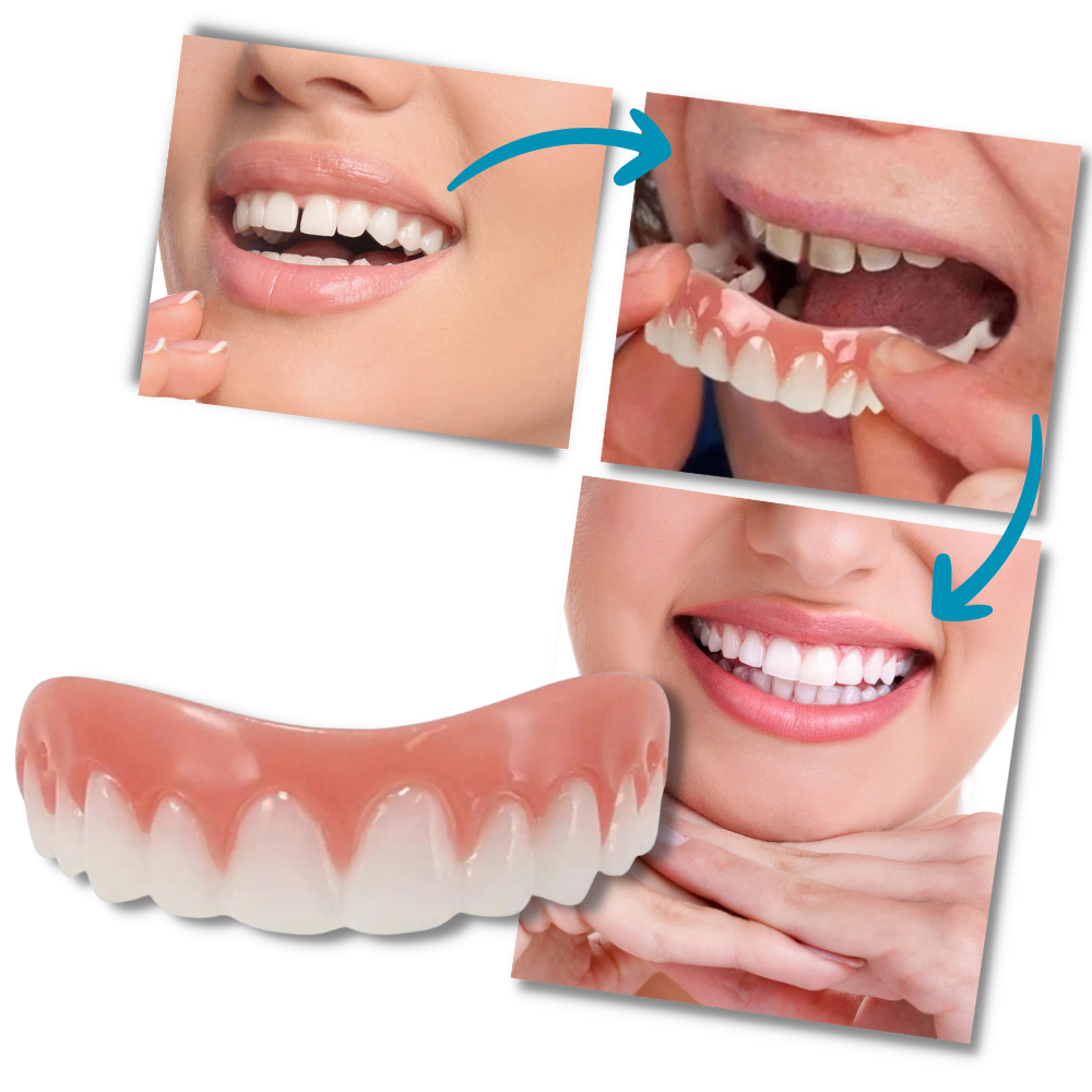 Carillas dentales Snap-On