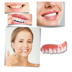 Carillas dentales Snap-On