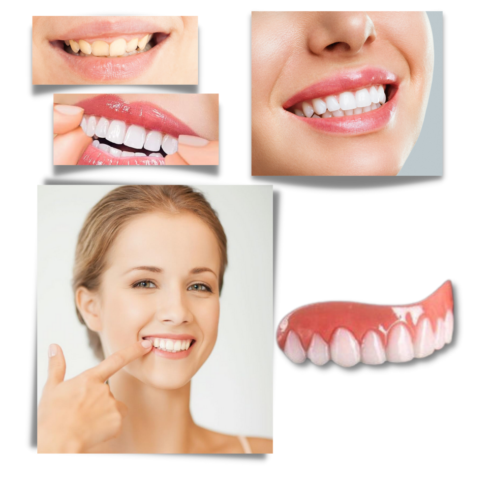 Carillas dentales Snap-On